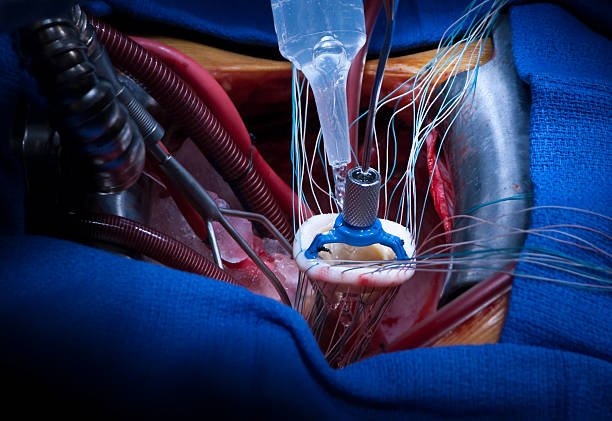 Mitral Valve Replacement.jpg